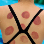 Cupping Therapy Athlete Philadelphia